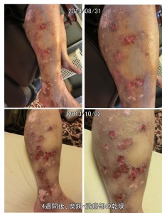 AtopicDermatitis-KR